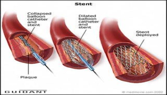 cateterisme-cardiac